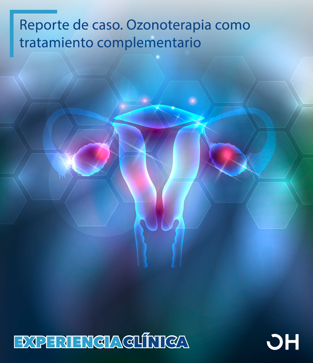 Ozono como terapia complementaria en el tratamiento de quiste de ovario