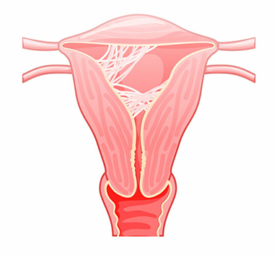 ozonoterapia peligros asherman