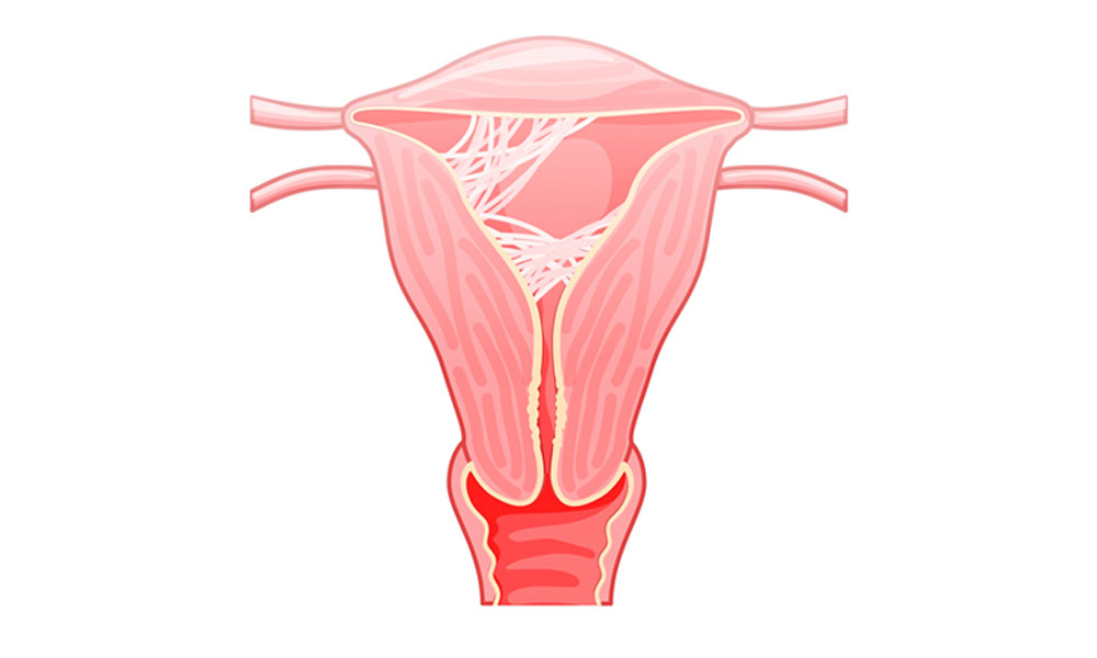 ozonoterapia peligros asherman