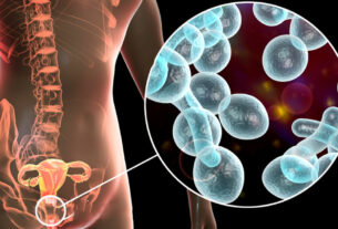 ozonoterapia tratamiento para candidiasis