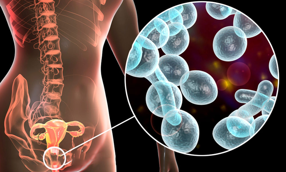 ozonoterapia tratamiento para candidiasis