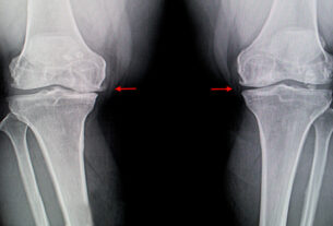 tratamiento ozonoterapia artrosis de rodilla xray