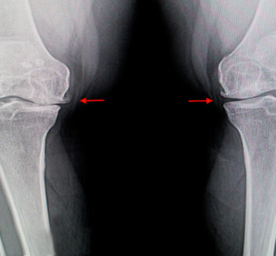 tratamiento ozonoterapia artrosis de rodilla xray