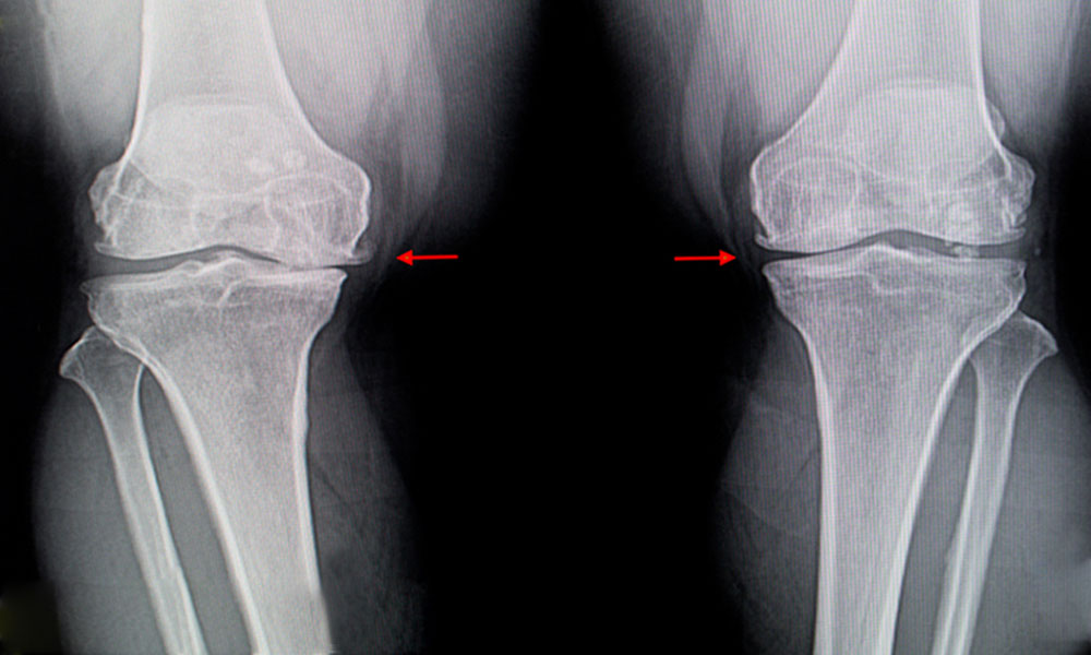 tratamiento ozonoterapia artrosis de rodilla xray