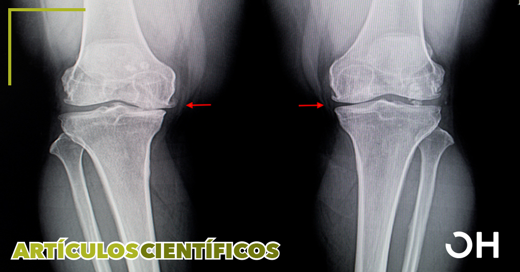 Eficacia de una inyección intraarticular de ozono para el dolor crónico de rodilla debido a osteoartritis