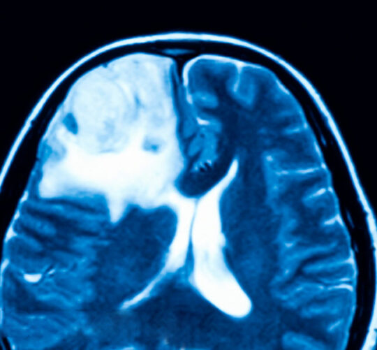 el ozono para que sirve isquemia reperfusion cerebral