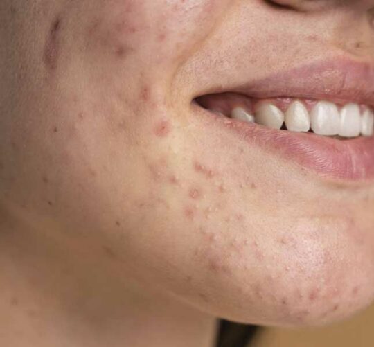 ozono beneficios para la piel acne