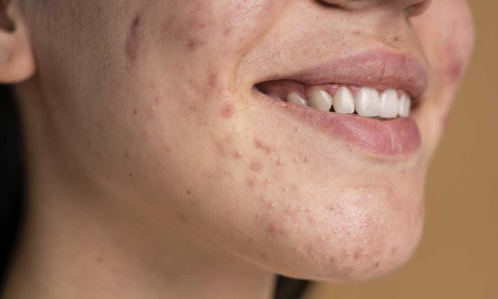 ozono beneficios para la piel acne