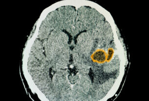 ozonoterapia cerca de mi glioma