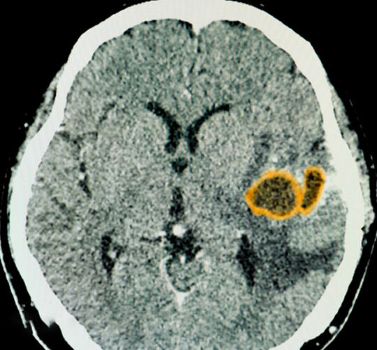 ozonoterapia cerca de mi glioma