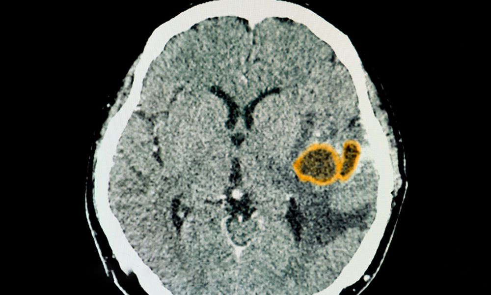 ozonoterapia cerca de mi glioma