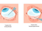 ilustración ojo de inyección intravitreal y subconjuntival