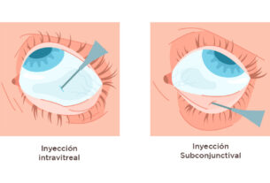 ilustración ojo de inyección intravitreal y subconjuntival