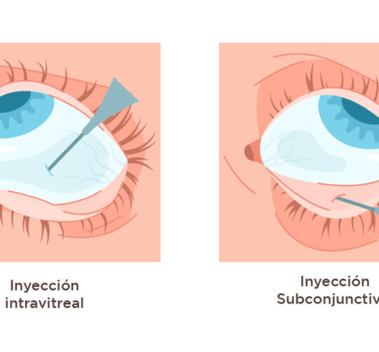 ilustración ojo de inyección intravitreal y subconjuntival