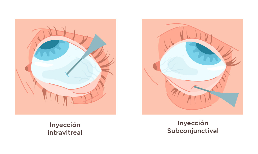 ilustración ojo de inyección intravitreal y subconjuntival