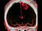 Resonancia magnetica mostrando accidente cerebrovascular