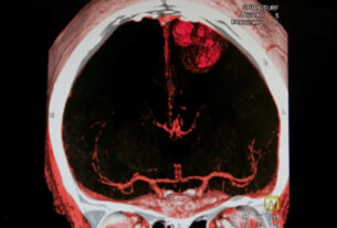 Resonancia magnetica mostrando accidente cerebrovascular