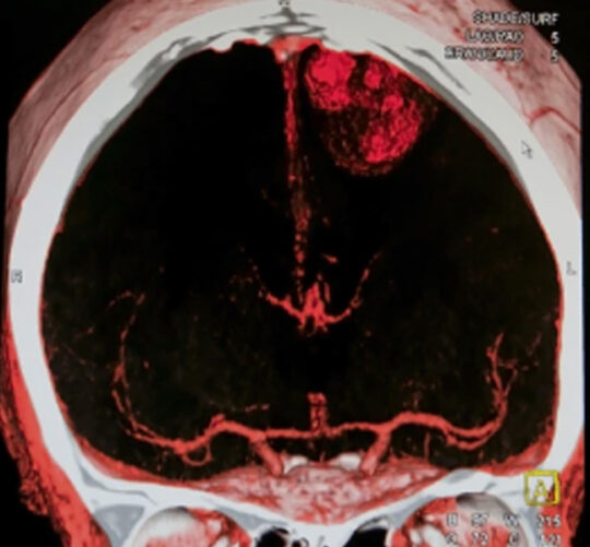 Resonancia magnetica mostrando accidente cerebrovascular