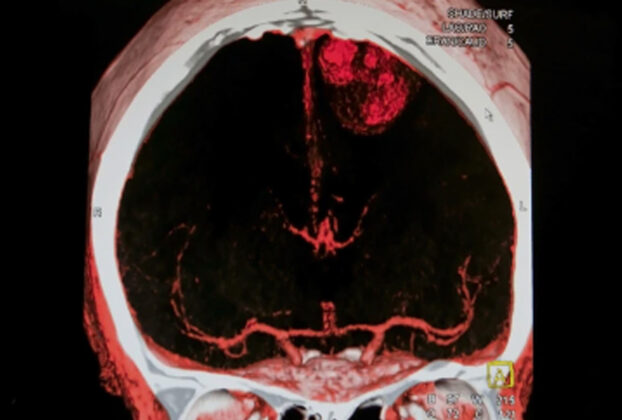 Resonancia magnetica mostrando accidente cerebrovascular