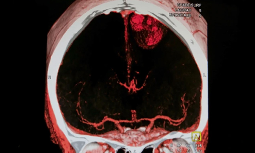 Resonancia magnetica mostrando accidente cerebrovascular