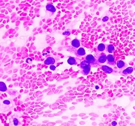 Adenocarcinoma celuas malignas