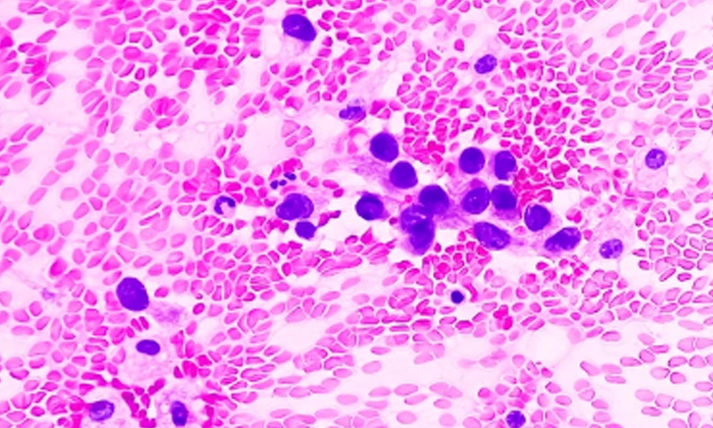 Adenocarcinoma celuas malignas