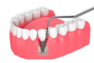 Molde de dentadura con implante de diente