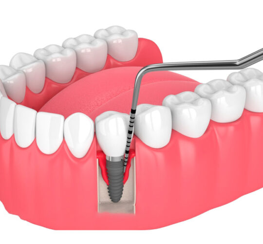 Molde de dentadura con implante de diente