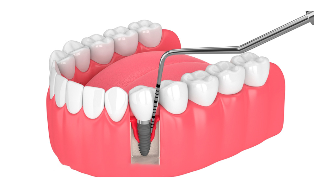 Molde de dentadura con implante de diente