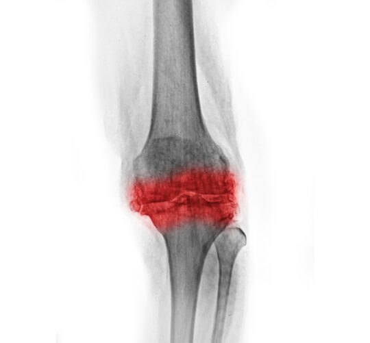 rayos x de rodilla