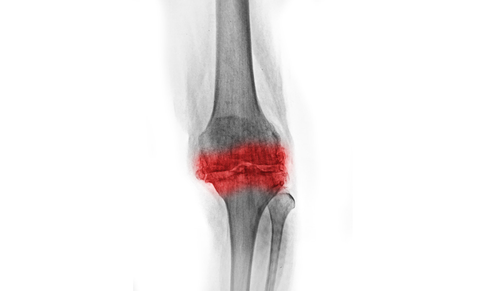 rayos x de rodilla