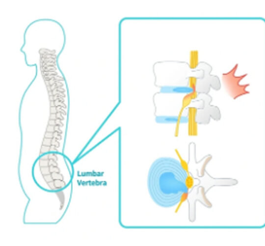 Ilustración de una columna con nervio ciático