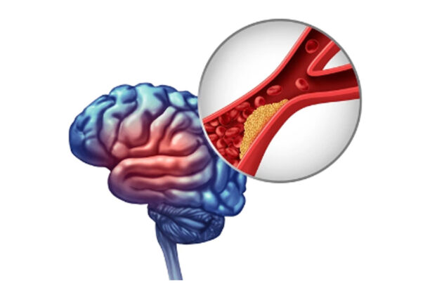 flujo sanguíneo cerebral bloqueado en una arteria