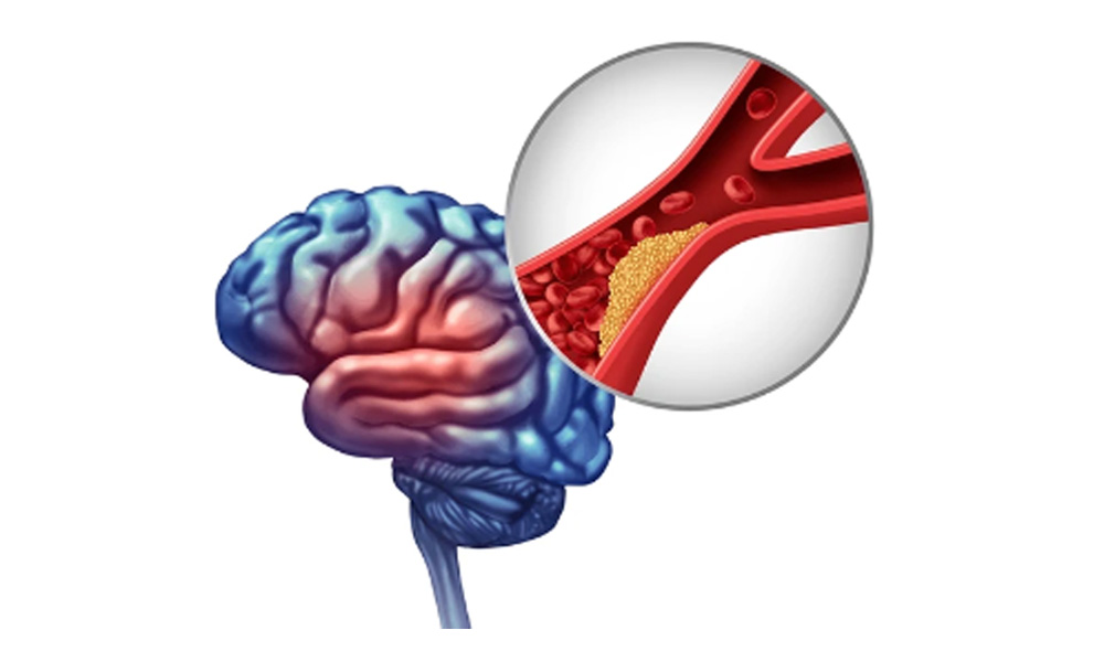 flujo sanguíneo cerebral bloqueado en una arteria