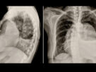 radiografía torácica y lateral del cáncer de mama