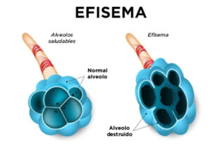 ilustración de efisema pulmonar