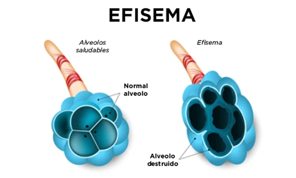 ilustración de efisema pulmonar