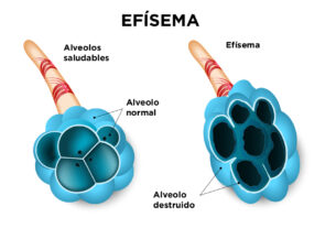 ilustración de efisema pulmonar