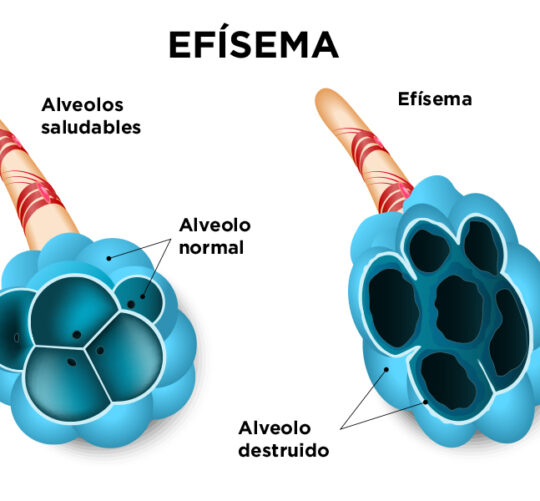 ilustración de efisema pulmonar