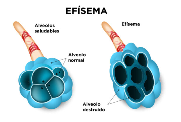 ilustración de efisema pulmonar