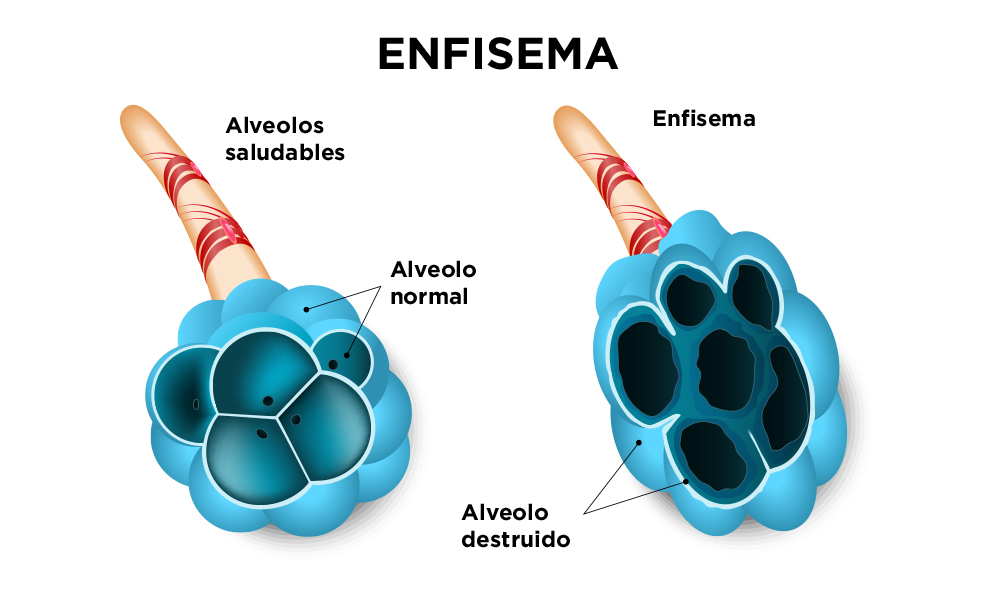 ilustración de enfisema pulmonar