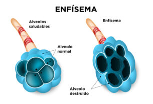 ilustración de enfisema pulmonar