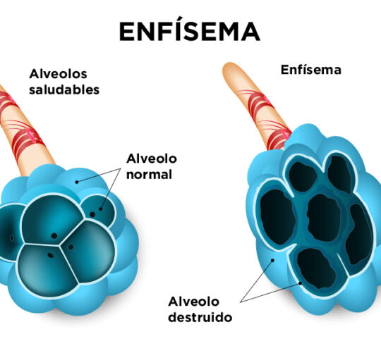 ilustración de enfisema pulmonar