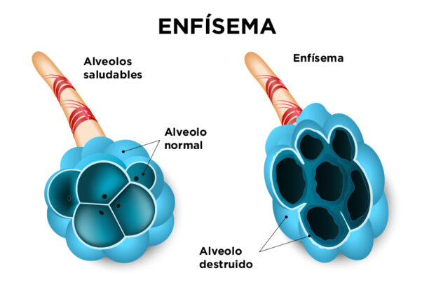 ilustración de enfisema pulmonar