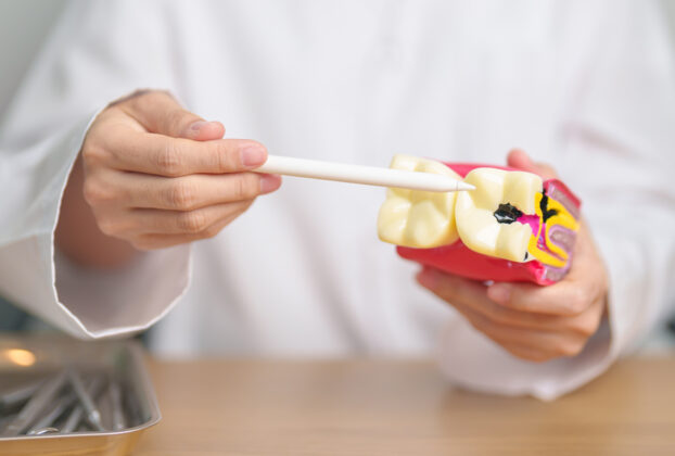 Modelado de muela con caries