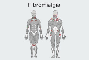 Esquema del cuerpo humano con zonas marcadas fibromialgia