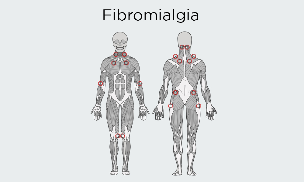 Esquema del cuerpo humano con zonas marcadas fibromialgia