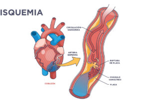 que es la ozonoterapia isquemia
