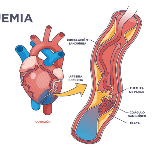 que es la ozonoterapia isquemia