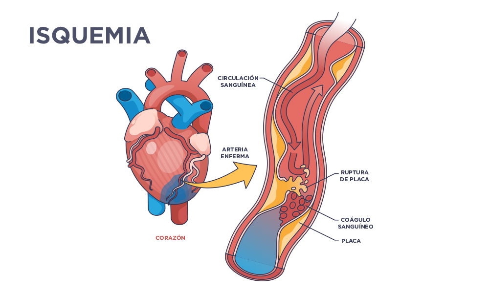 que es la ozonoterapia isquemia